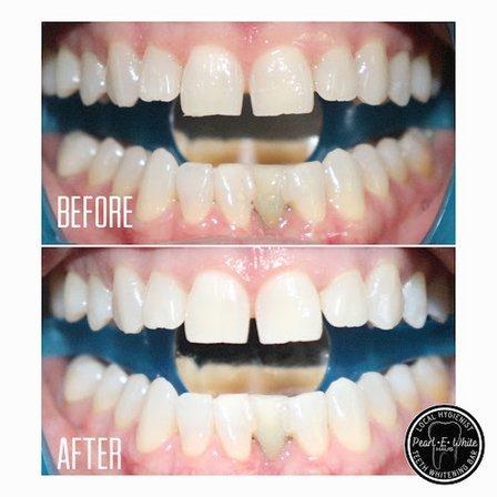 Pearl E White Haus Teeth Whitening Bar