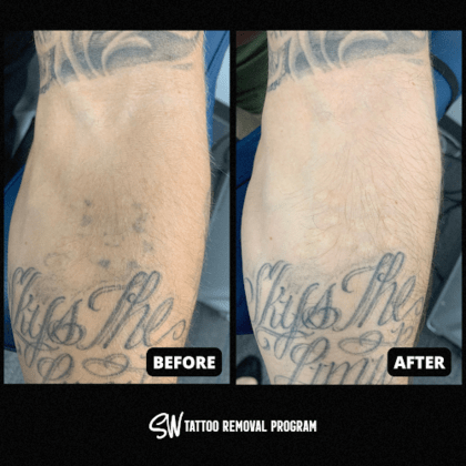 SW Tattoo Removal Program