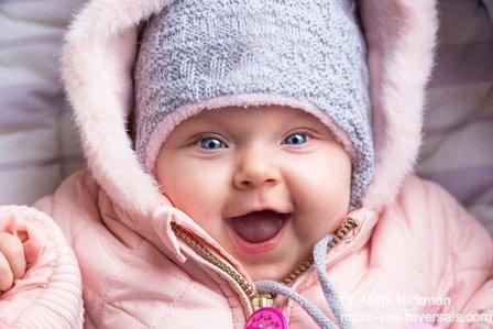 Microsurgical Vasectomy Reversals by Dr. Mark Hickman