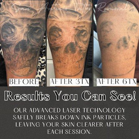 San Antonio Tattoo Removal Co.